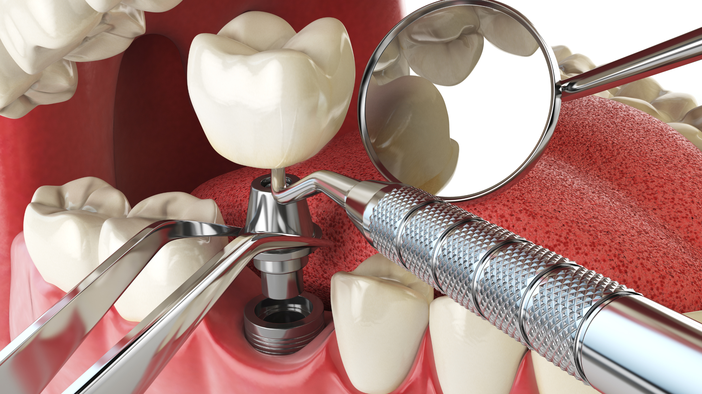 cost dental implant